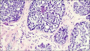 Bazinių ląstelių karcinoma